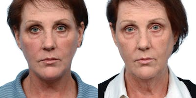 Deep Plane Facelift Before & After Gallery - Patient 964016 - Image 1