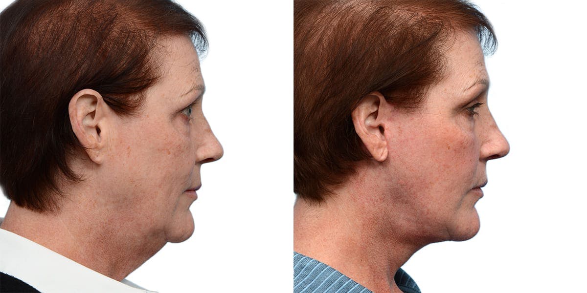Deep Plane Facelift Before & After Gallery - Patient 964016 - Image 2