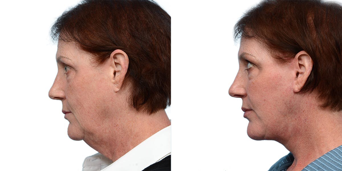 Deep Plane Facelift Before & After Gallery - Patient 964016 - Image 3