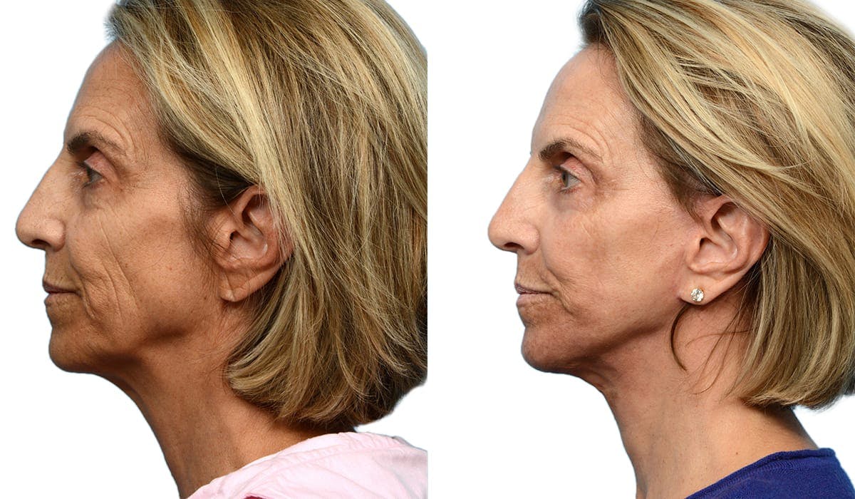 Deep Plane Facelift Before & After Gallery - Patient 189974 - Image 2