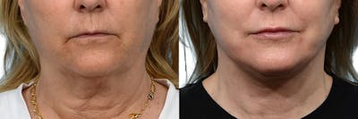 Deep Plane Facelift Before & After Gallery - Patient 315819 - Image 1