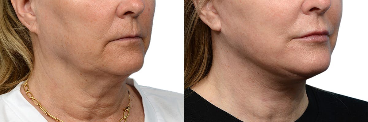 Deep Plane Facelift Before & After Gallery - Patient 315819 - Image 2