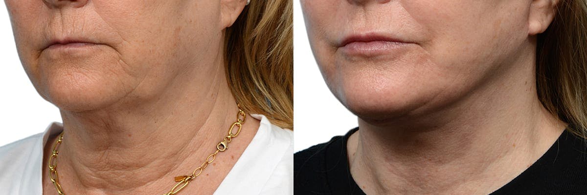 Deep Plane Facelift Before & After Gallery - Patient 315819 - Image 3