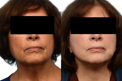 Deep Plane Facelift Before & After Gallery - Patient 414544 - Image 1