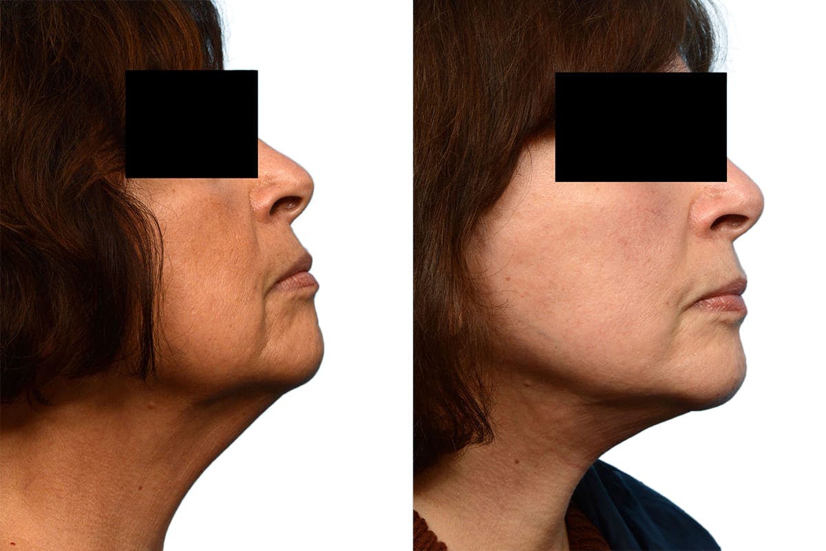 Deep Plane Facelift Before & After Gallery - Patient 414544 - Image 2