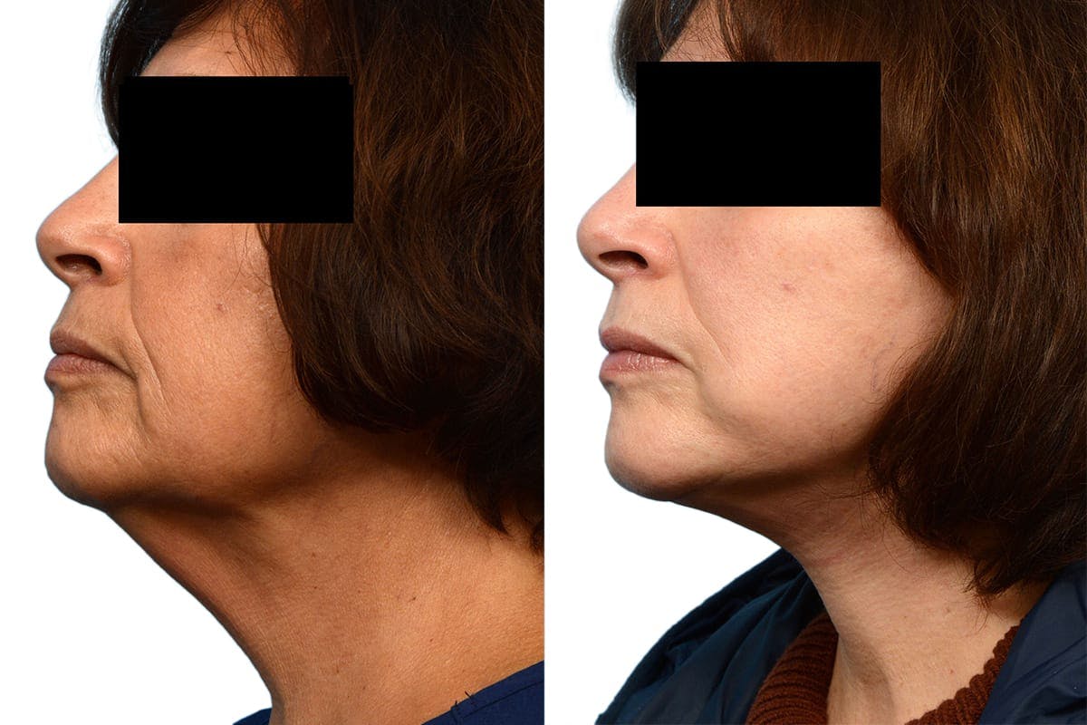 Deep Plane Facelift Before & After Gallery - Patient 414544 - Image 3