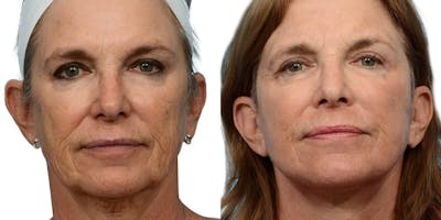 Deep Plane Facelift Before & After Gallery - Patient 515174 - Image 1