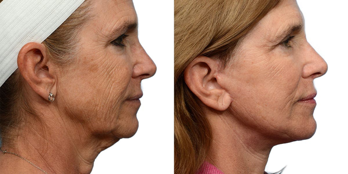 Deep Plane Facelift Before & After Gallery - Patient 515174 - Image 2