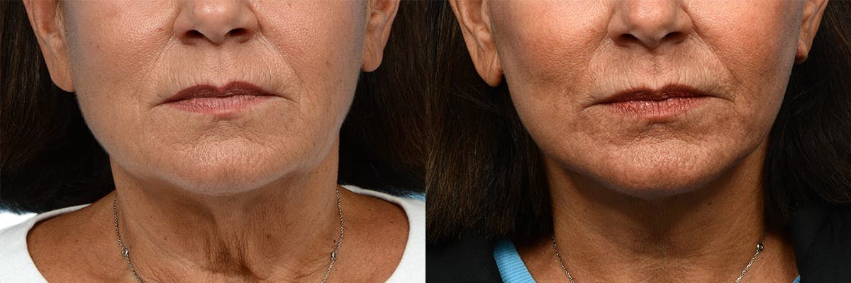 Deep Plane Facelift Before & After Gallery - Patient 169766 - Image 1
