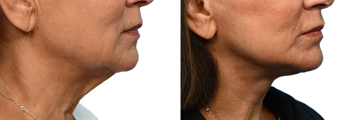 Deep Plane Facelift Before & After Gallery - Patient 169766 - Image 2