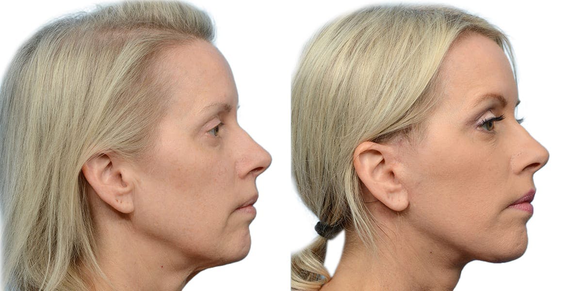 Deep Plane Facelift Before & After Gallery - Patient 552978 - Image 1