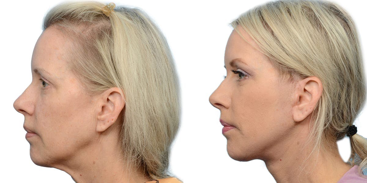 Deep Plane Facelift Before & After Gallery - Patient 552978 - Image 2