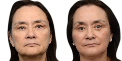 Deep Plane Facelift Before & After Gallery - Patient 688756 - Image 1