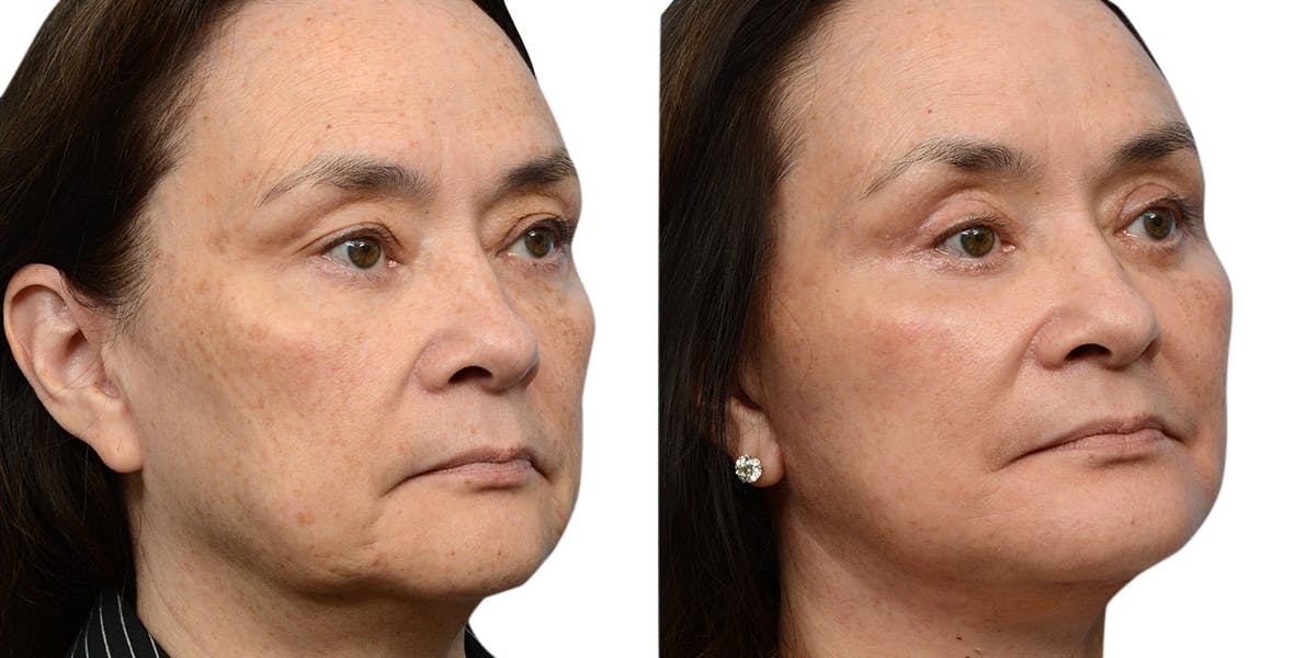 Deep Plane Facelift Before & After Gallery - Patient 688756 - Image 2