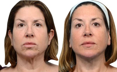 Deep Plane Facelift Before & After Gallery - Patient 660021 - Image 1