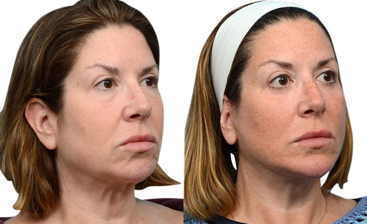 Deep Plane Facelift Before & After Gallery - Patient 660021 - Image 2