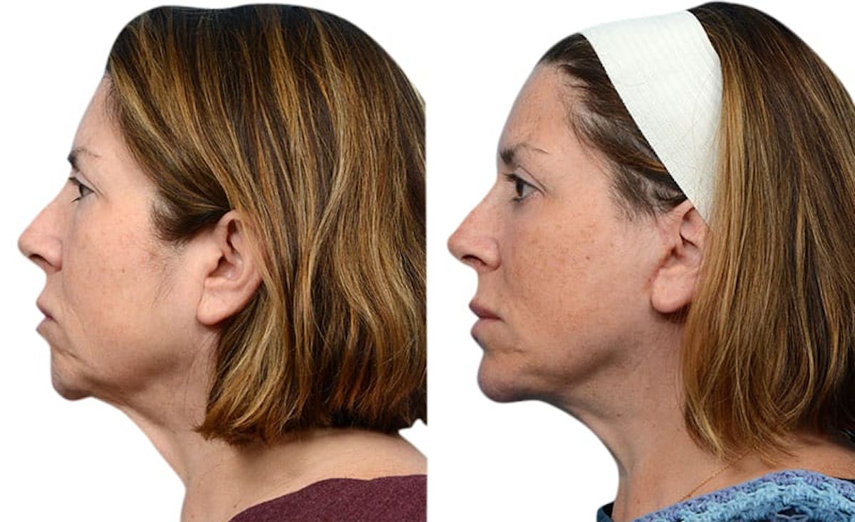 Deep Plane Facelift Before & After Gallery - Patient 660021 - Image 3