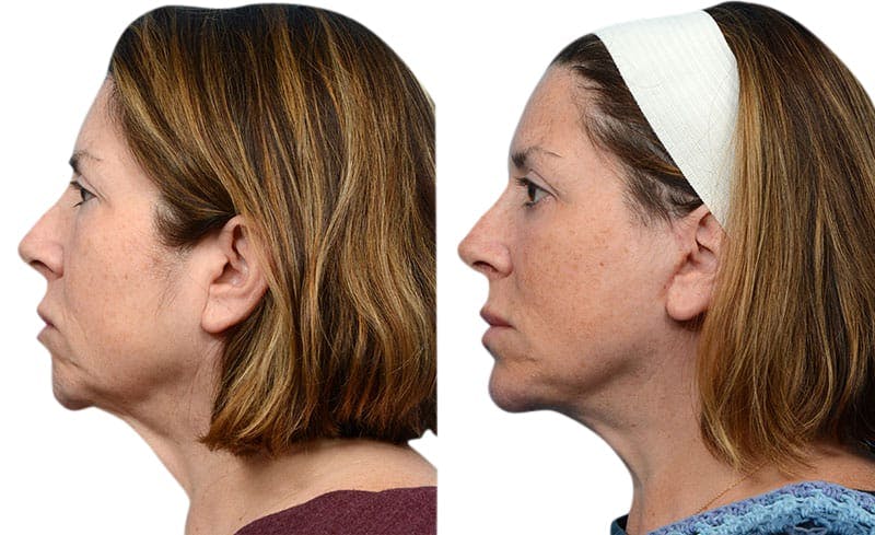 Deep Plane Facelift Before & After Gallery - Patient 660021 - Image 3