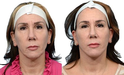 Deep Plane Facelift Before & After Gallery - Patient 108110 - Image 1