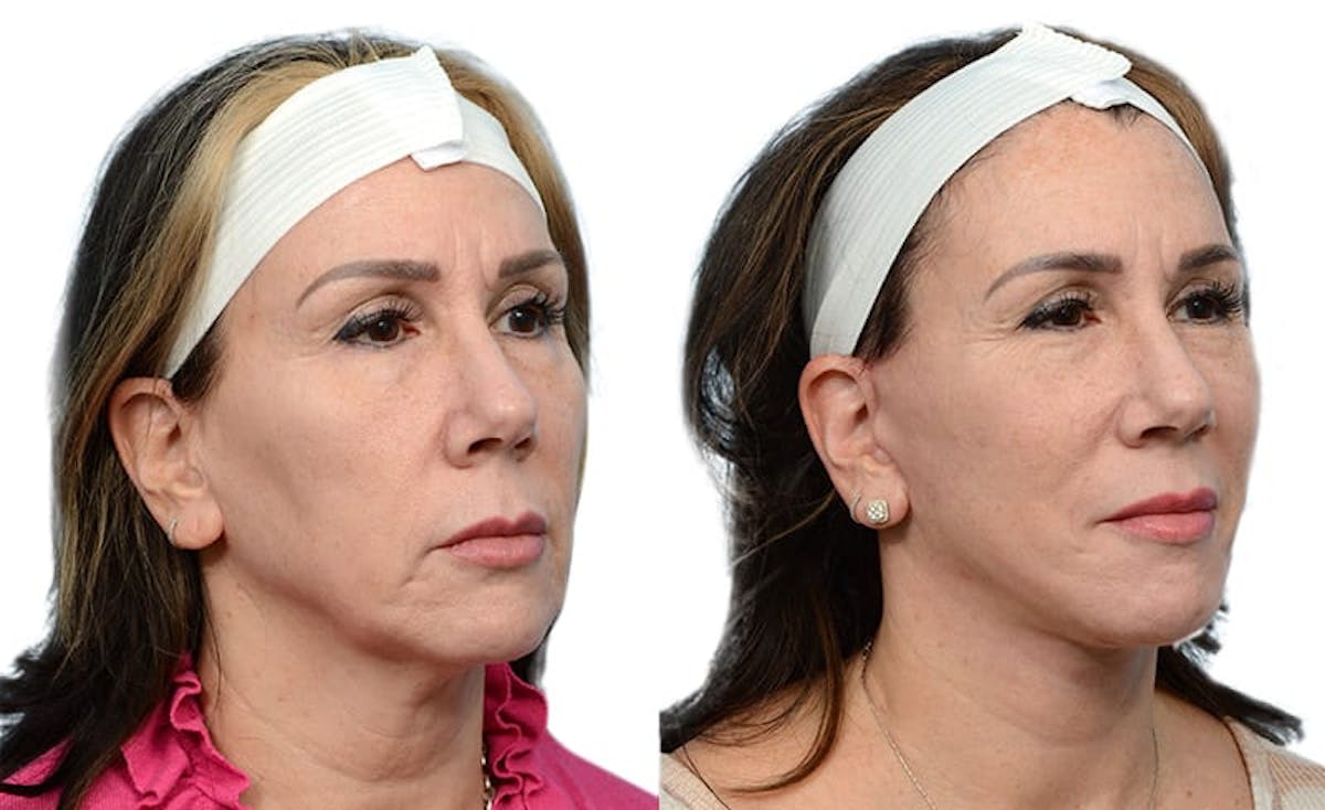 Deep Plane Facelift Before & After Gallery - Patient 108110 - Image 2