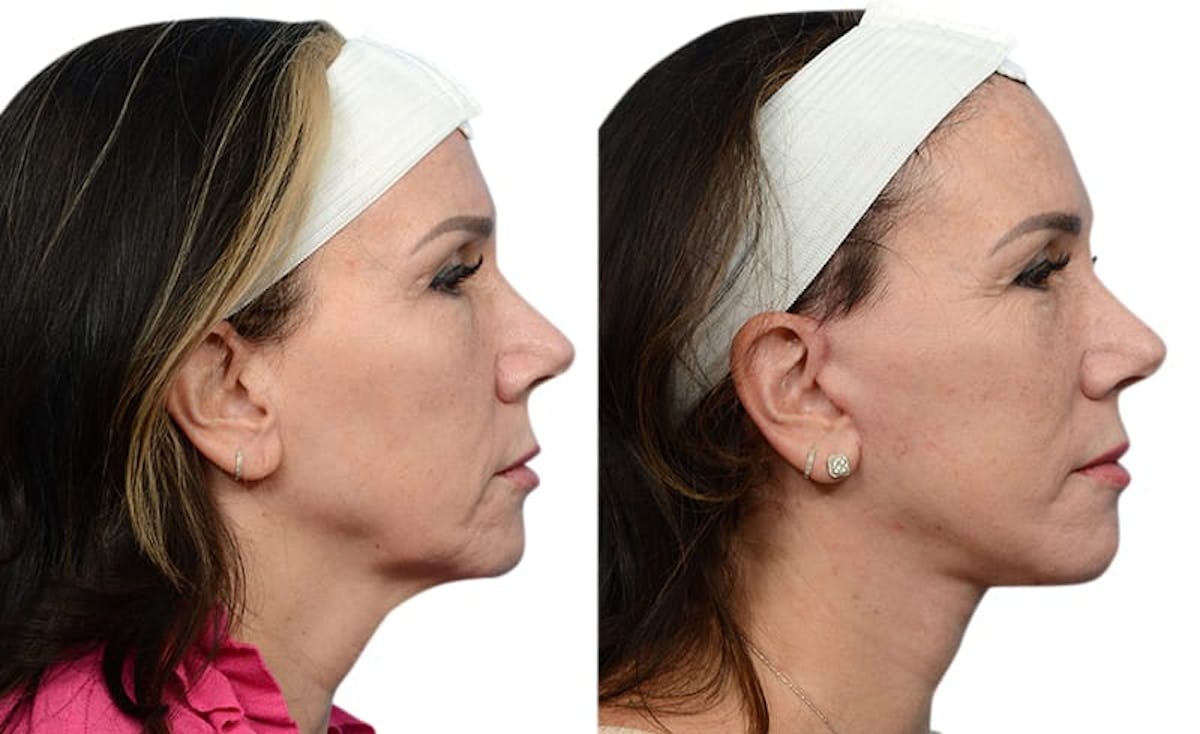 Deep Plane Facelift Before & After Gallery - Patient 108110 - Image 3