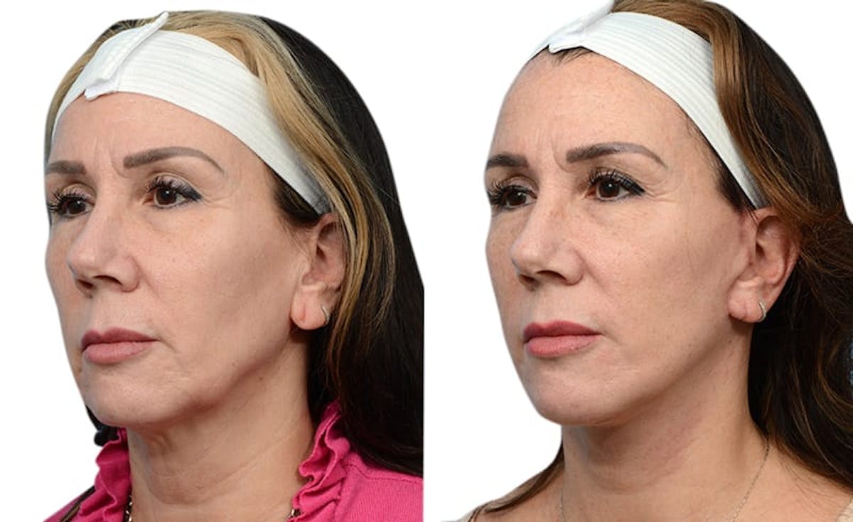 Deep Plane Facelift Before & After Gallery - Patient 108110 - Image 4
