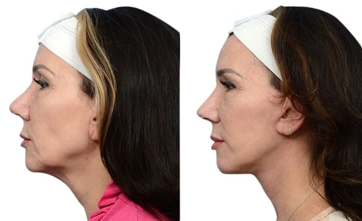 Deep Plane Facelift Before & After Gallery - Patient 108110 - Image 5