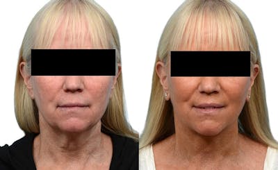 Deep Plane Facelift Before & After Gallery - Patient 660261 - Image 1