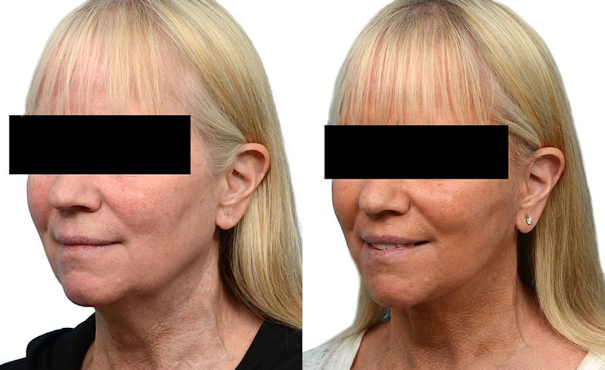 Deep Plane Facelift Before & After Gallery - Patient 660261 - Image 2