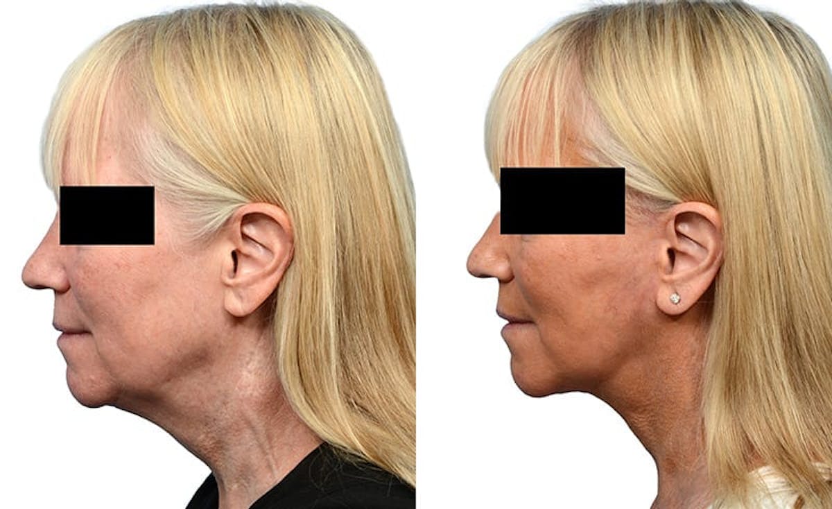 Deep Plane Facelift Before & After Gallery - Patient 660261 - Image 3