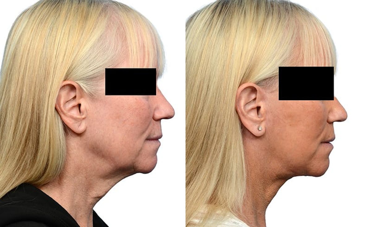Facelift Before & After Gallery - Patient 284443 - Image 4