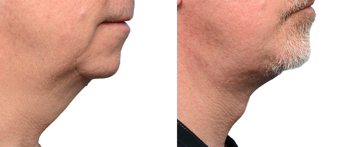 Deep Plane Facelift Before & After Gallery - Patient 171697 - Image 1