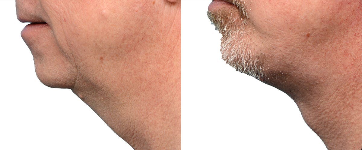 Deep Plane Facelift Before & After Gallery - Patient 171697 - Image 2