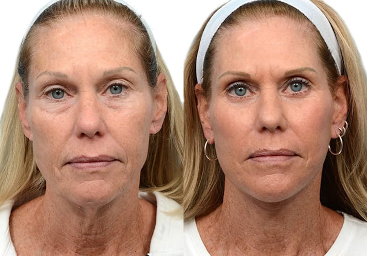 Deep Plane Facelift Before & After Gallery - Patient 318945 - Image 1