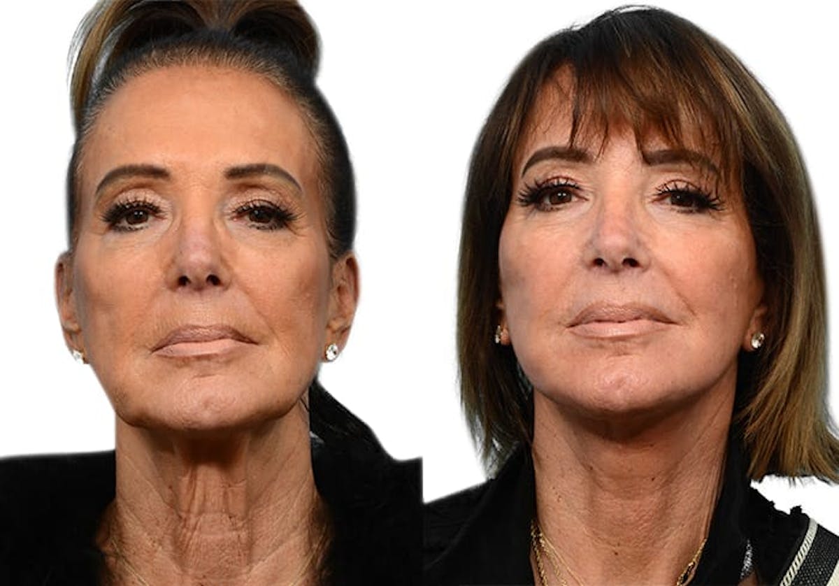 Deep Plane Facelift Before & After Gallery - Patient 409326 - Image 1