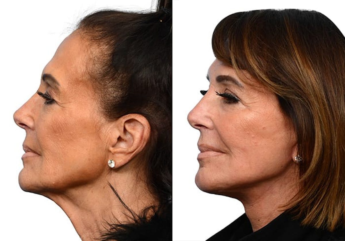 Deep Plane Facelift Before & After Gallery - Patient 409326 - Image 3