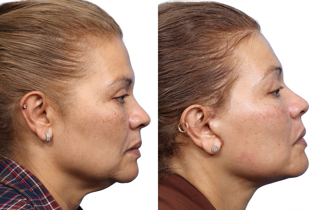 Deep Plane Facelift Before & After Gallery - Patient 194152 - Image 2