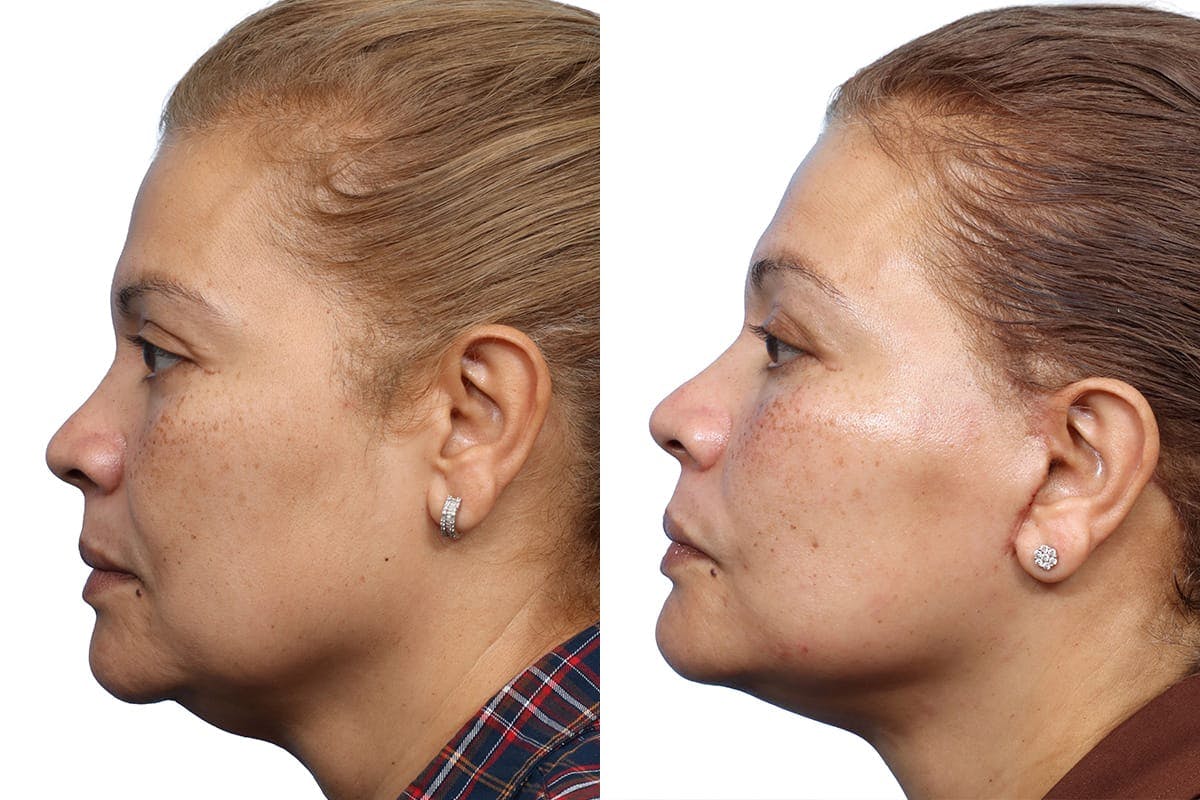 Facelift Before & After Gallery - Patient 211999 - Image 3