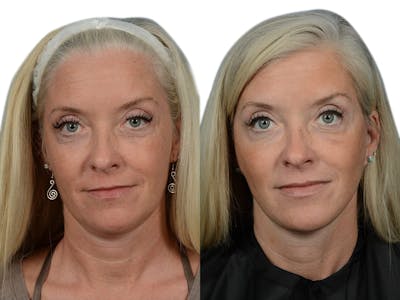 Facelift Before & After Gallery - Patient 290525 - Image 1