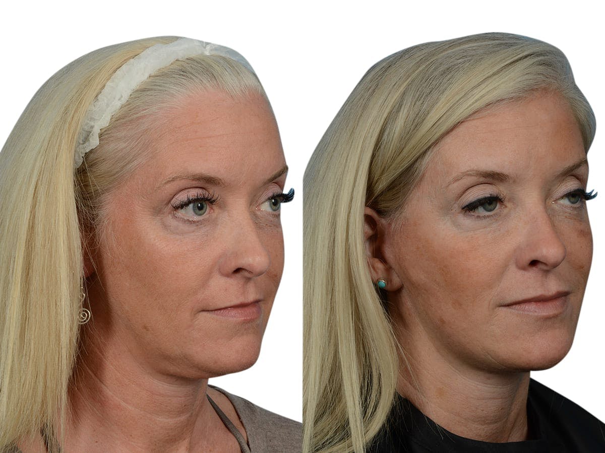 Facelift Before & After Gallery - Patient 290525 - Image 2