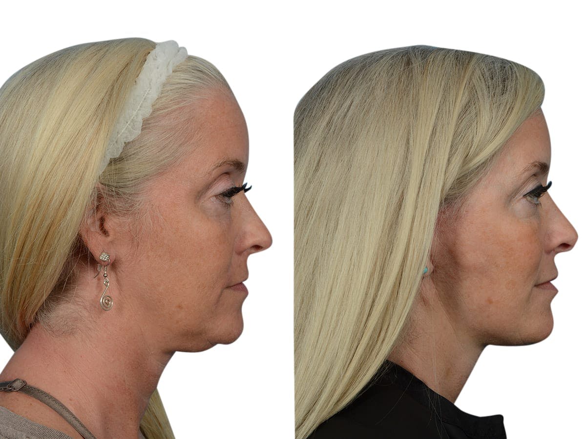 Facelift Before & After Gallery - Patient 290525 - Image 3
