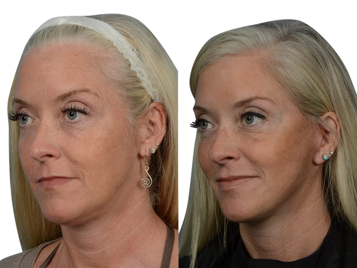 Facelift Before & After Gallery - Patient 290525 - Image 4