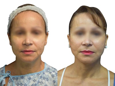 Facelift Before & After Gallery - Patient 972504 - Image 1