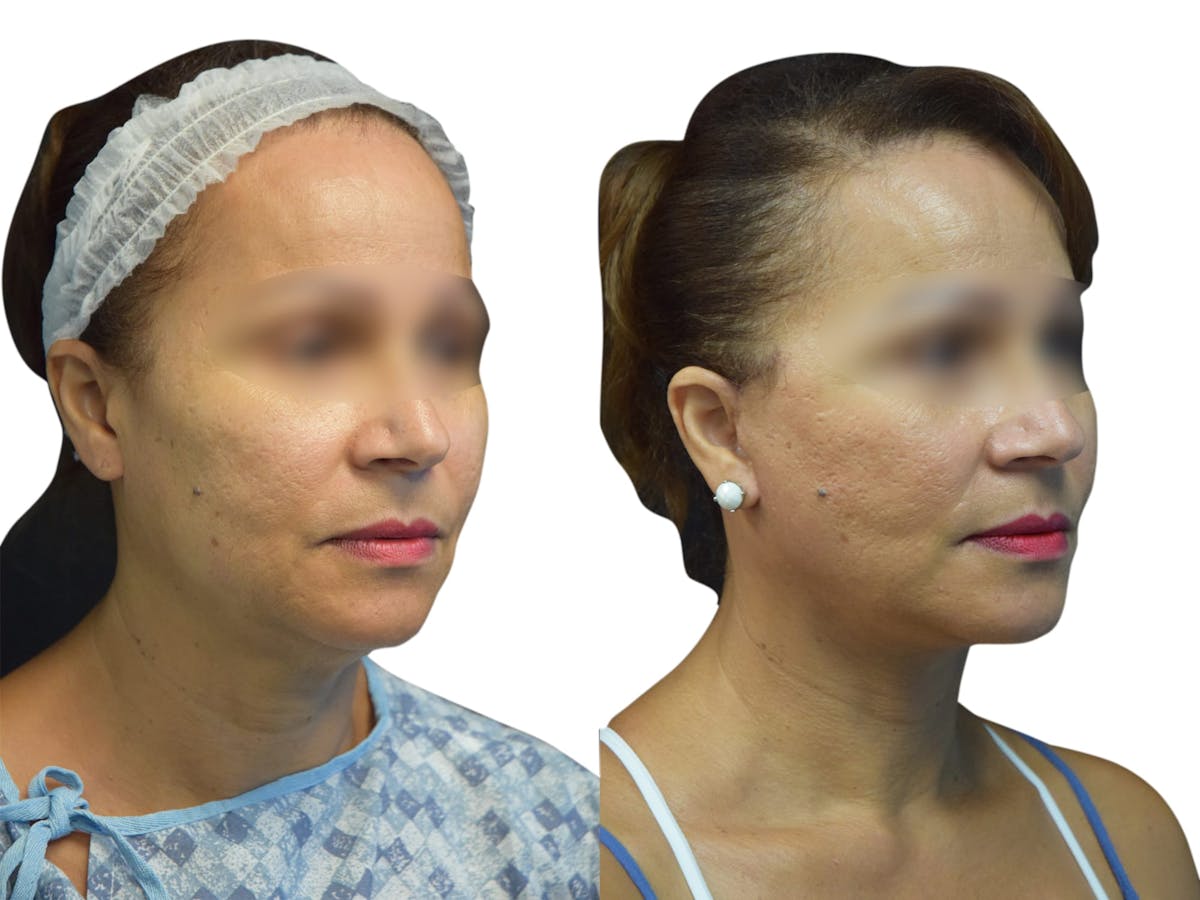 Facelift Before & After Gallery - Patient 972504 - Image 2