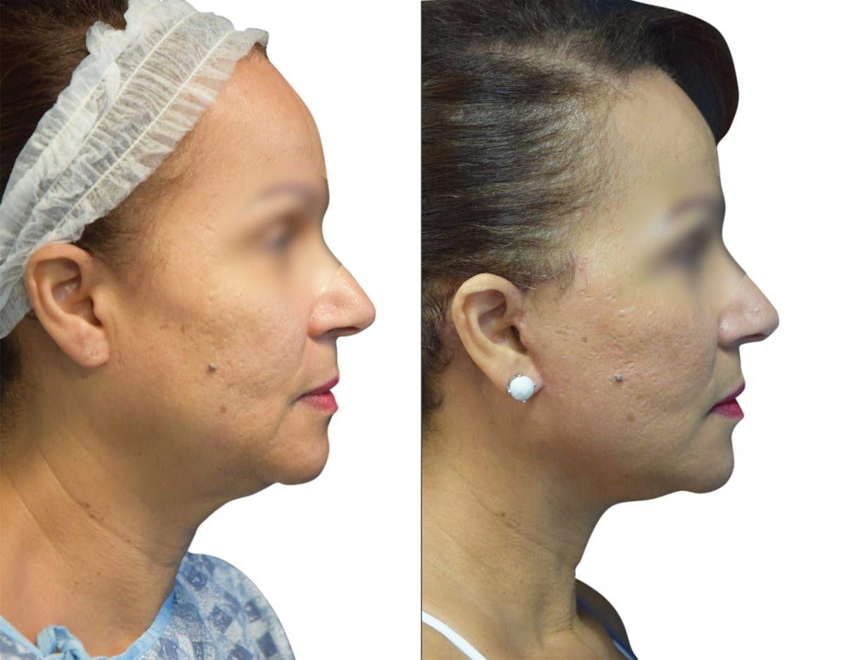 Facelift Before & After Gallery - Patient 972504 - Image 3