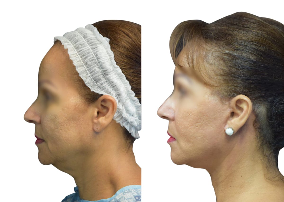 Facelift Before & After Gallery - Patient 972504 - Image 4