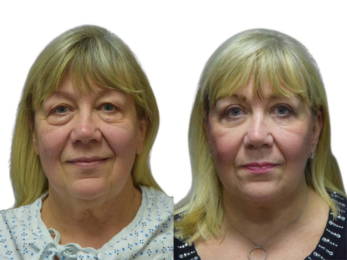 Facelift Before & After Gallery - Patient 210207 - Image 1