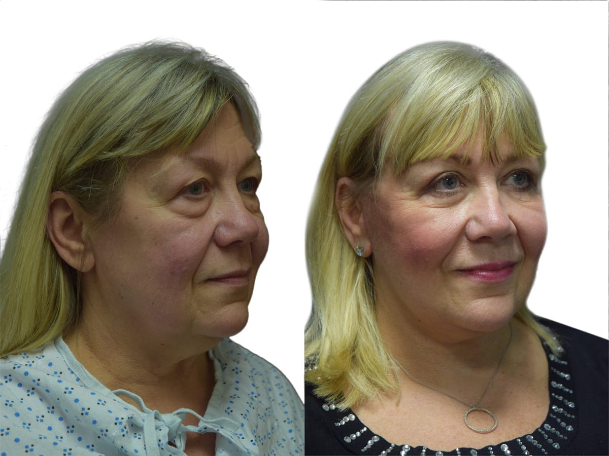 Facelift Before & After Gallery - Patient 210207 - Image 2
