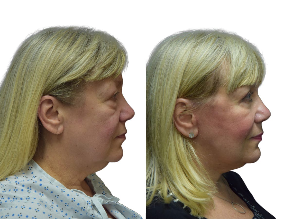 Facelift Before & After Gallery - Patient 210207 - Image 3