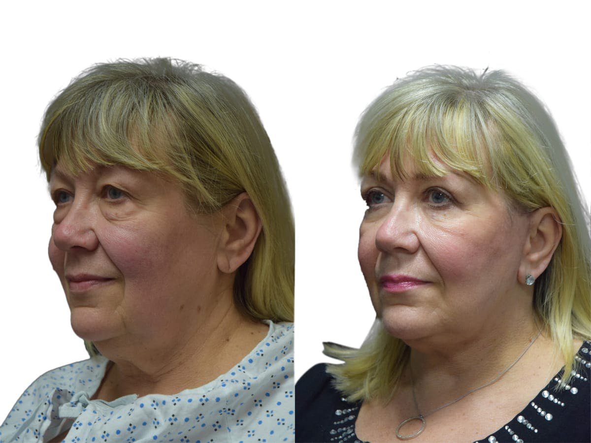 Facelift Before & After Gallery - Patient 210207 - Image 4